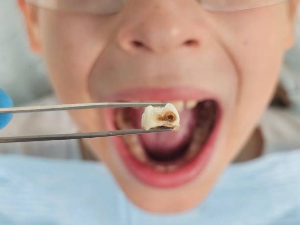 Best Emergency Root Canal Treatment in Roberta, GA